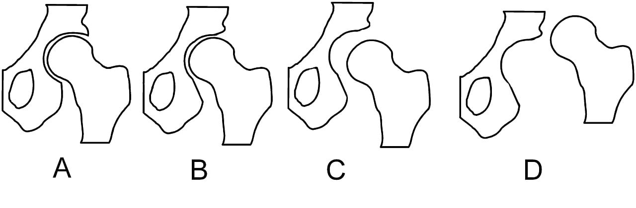 Schematic illustration comparing normal hip to various degrees of developmental dysplasia of the hip