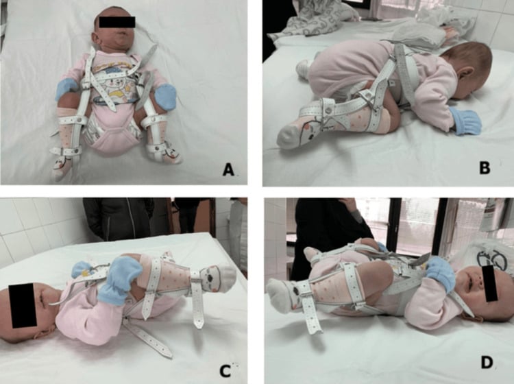 Four clinical photographs labelled A to D of an infant wearing a Pavlik harness in four different lying positions, with the face obscured.