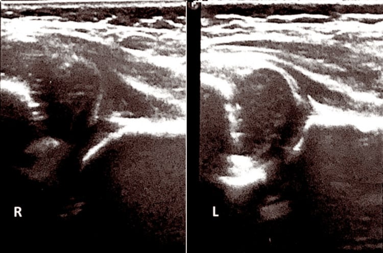 Paired infant hip ultrasounds labelled R and L, without angle lines drawn.