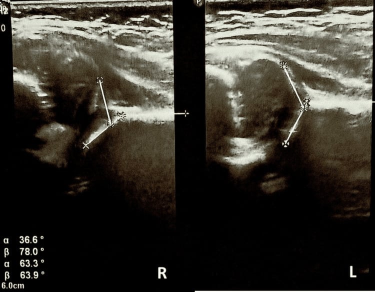 Paired infant hip ultrasounds labelled R and L with Graf angle lines drawn, and a readout printing alpha 36.6 with beta 78.0 degrees and alpha 63.3 with beta 63.9 degrees.