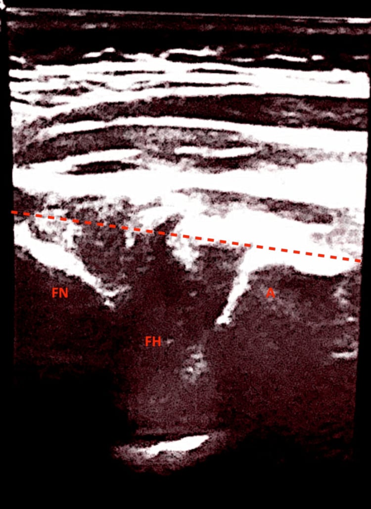 Infant hip ultrasound with a red dashed reference line and the printed labels FN, FH and A.