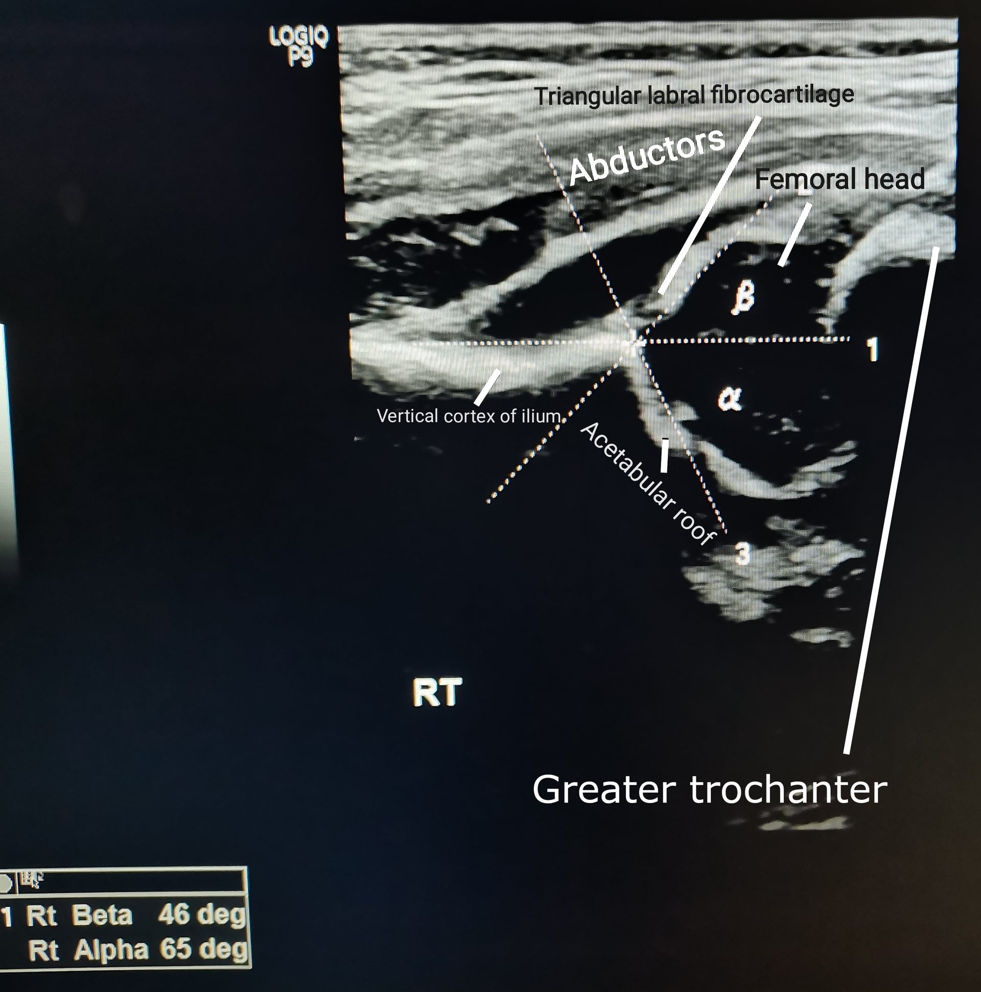 Real coronal Graf ultrasound of an infant right hip with alpha and beta angle measurements