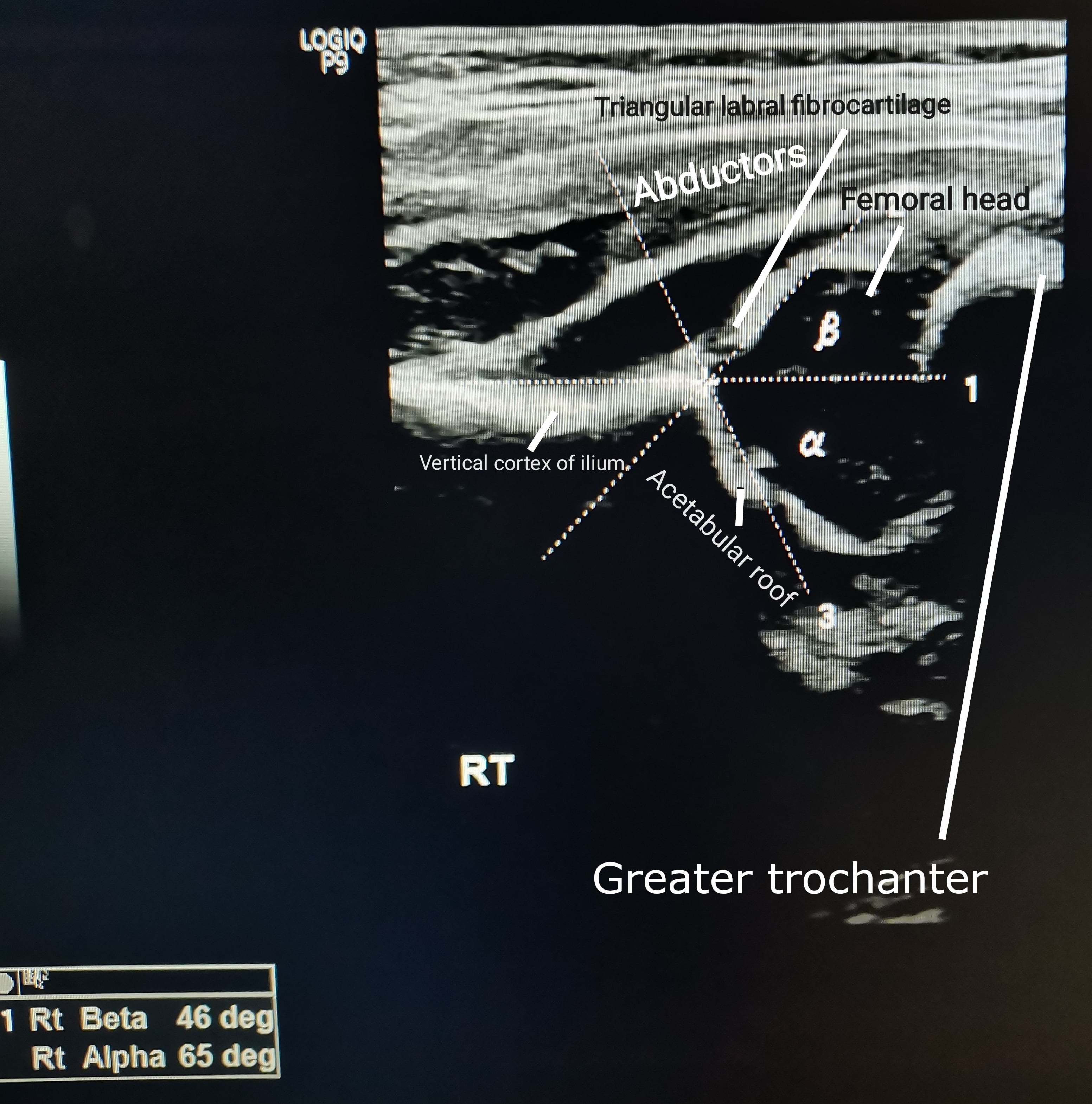 Real coronal Graf ultrasound of an infant right hip with alpha and beta angle measurements