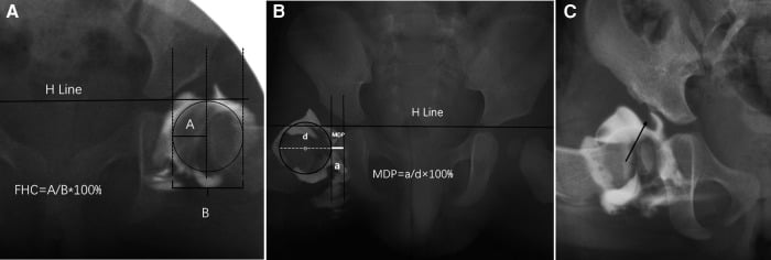 Three-panel arthrogram figure: femoral head coverage measured as A over B against the H line, the medial dye pool measured as a over d, and an arthrogram with a black marker line.