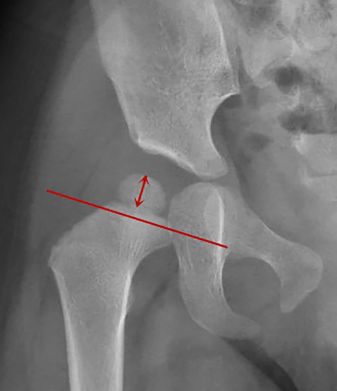 Anteroposterior radiograph of a single child's hip with a red line drawn across the proximal femur beneath the ossific nucleus and a double-headed red arrow between the nucleus and the line.