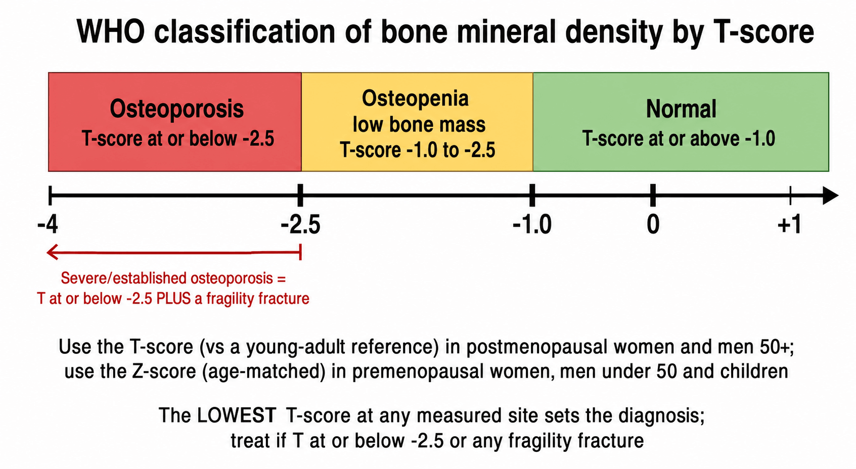 Diagram of the WHO bone mineral density classification on a T-score axis: normal, osteopenia and osteoporosis