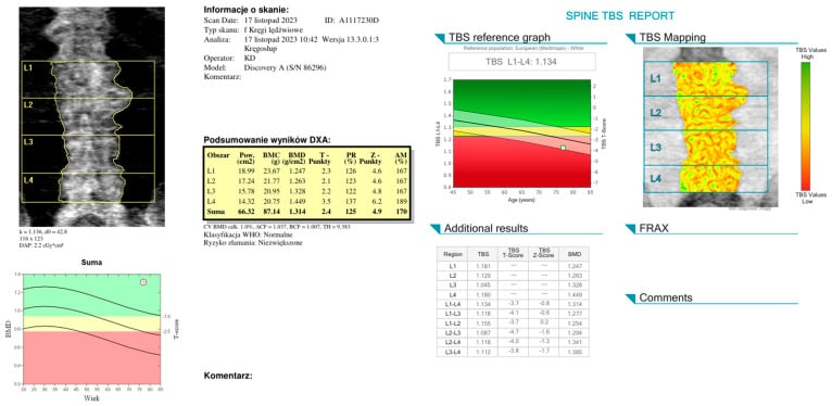 Lumbar spine DXA report showing normal areal BMD despite degenerative change, with degraded trabecular bone score.