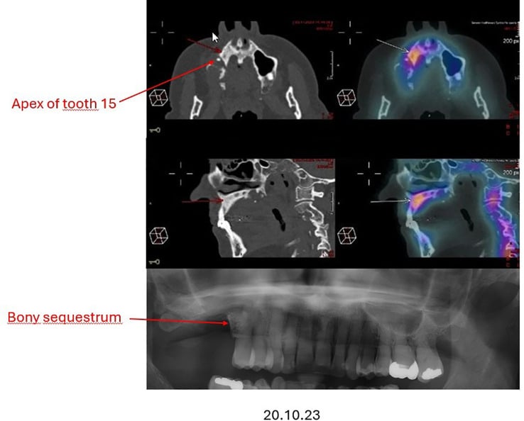 PET-CT and orthopantomogram showing medication-related osteonecrosis of the jaw.