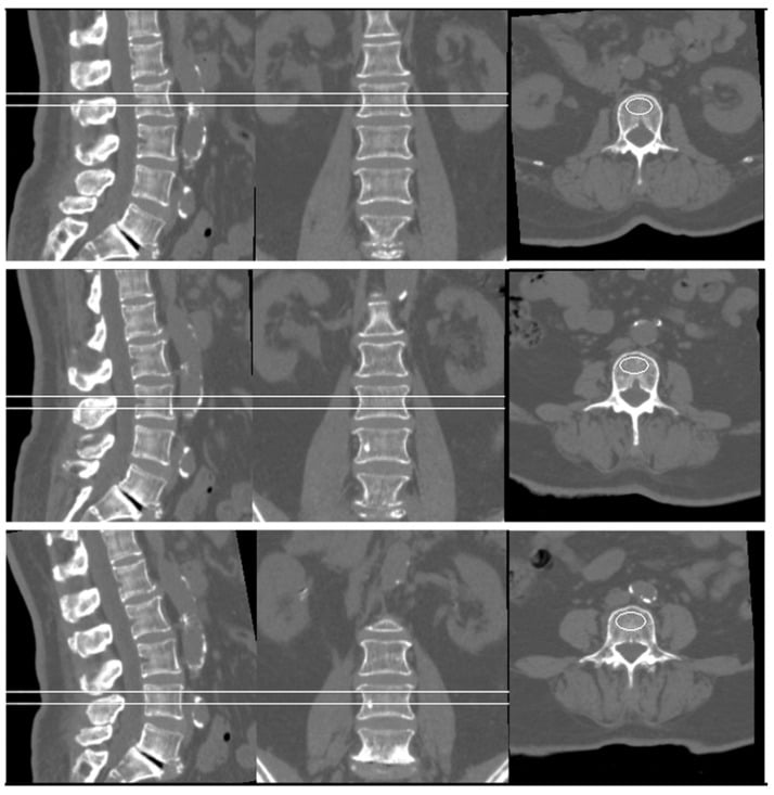 Sagittal, coronal and axial quantitative CT images showing trabecular regions of interest in lumbar vertebrae L2 to L4.