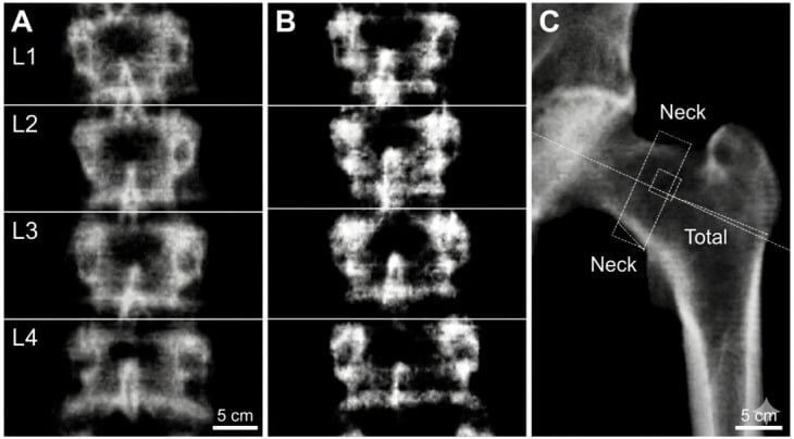 Representative DXA scans showing normal lumbar spine BMD, osteopenic lumbar spine BMD and osteoporotic left hip BMD.