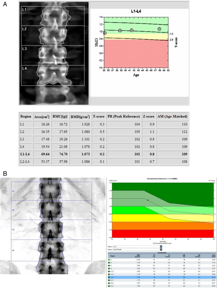 Hologic and GE Lunar lumbar spine DXA reports with serial follow-up measurements.