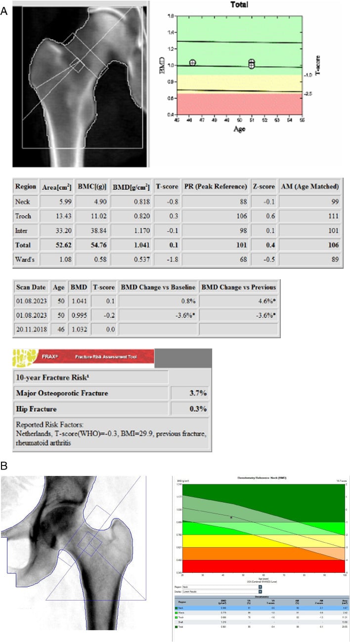 Hologic right hip DXA with serial follow-up and GE Lunar left hip DXA report.