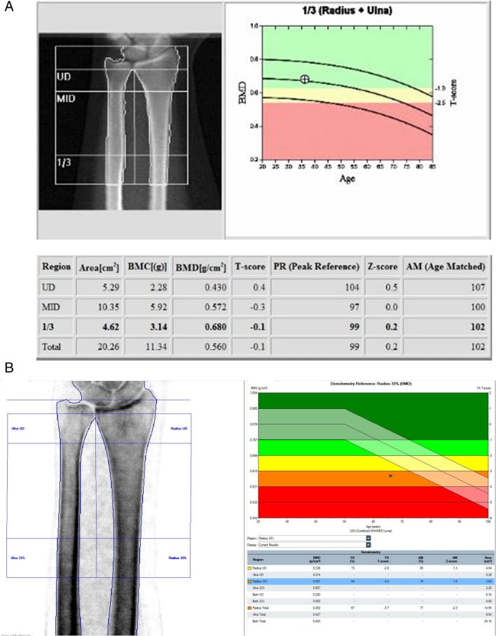 Hologic and GE Lunar one-third radius DXA reports showing normal and osteoporotic classifications.