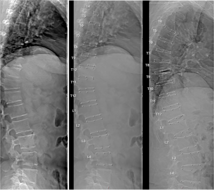 DXA vertebral fracture assessment images showing mild wedge and moderate wedge and crush vertebral deformities with six-point measurements.