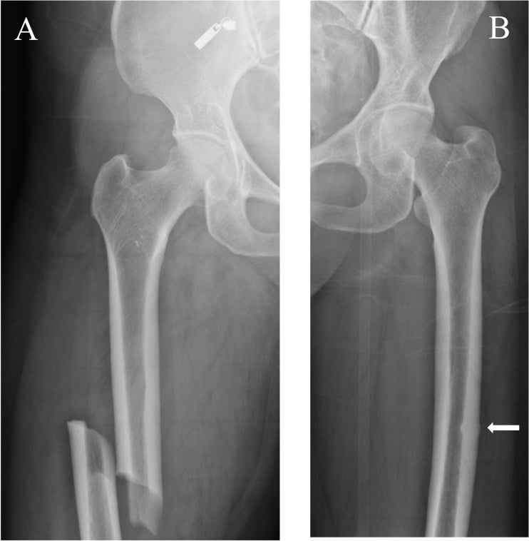 AP radiographs showing a complete atypical femoral fracture on one side and an incomplete lateral-cortical atypical femoral fracture on the other.