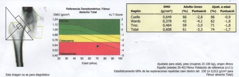 DXA report of the femoral neck showing the hip scan image, a reference graph and a bone mineral density table