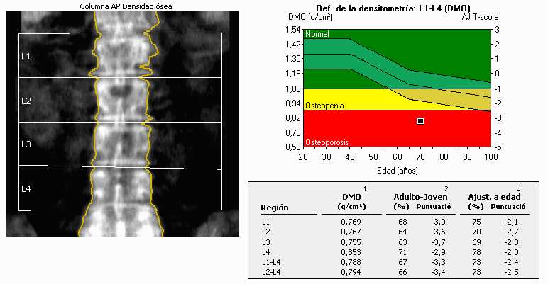 DXA report of the lumbar spine showing the scan image, an age-versus-BMD reference graph and a bone mineral density table