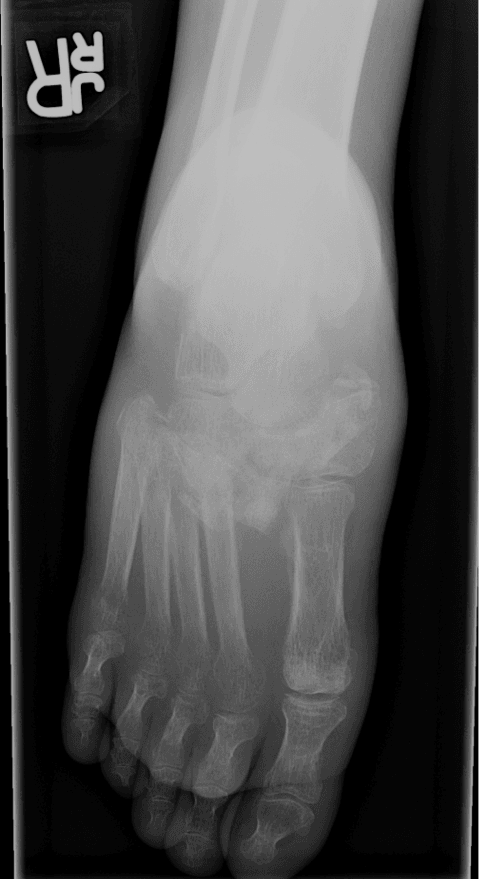 Dorsoplantar radiograph of a diabetic foot with midfoot disorganisation consistent with Charcot neuroarthropathy