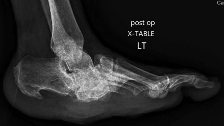 Post-operative cross-table lateral radiograph of a left Charcot foot after plantar exostectomy, with the midfoot still collapsed