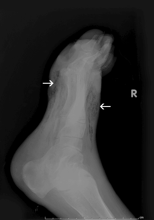 Lateral radiograph of a diabetic foot with soft-tissue gas