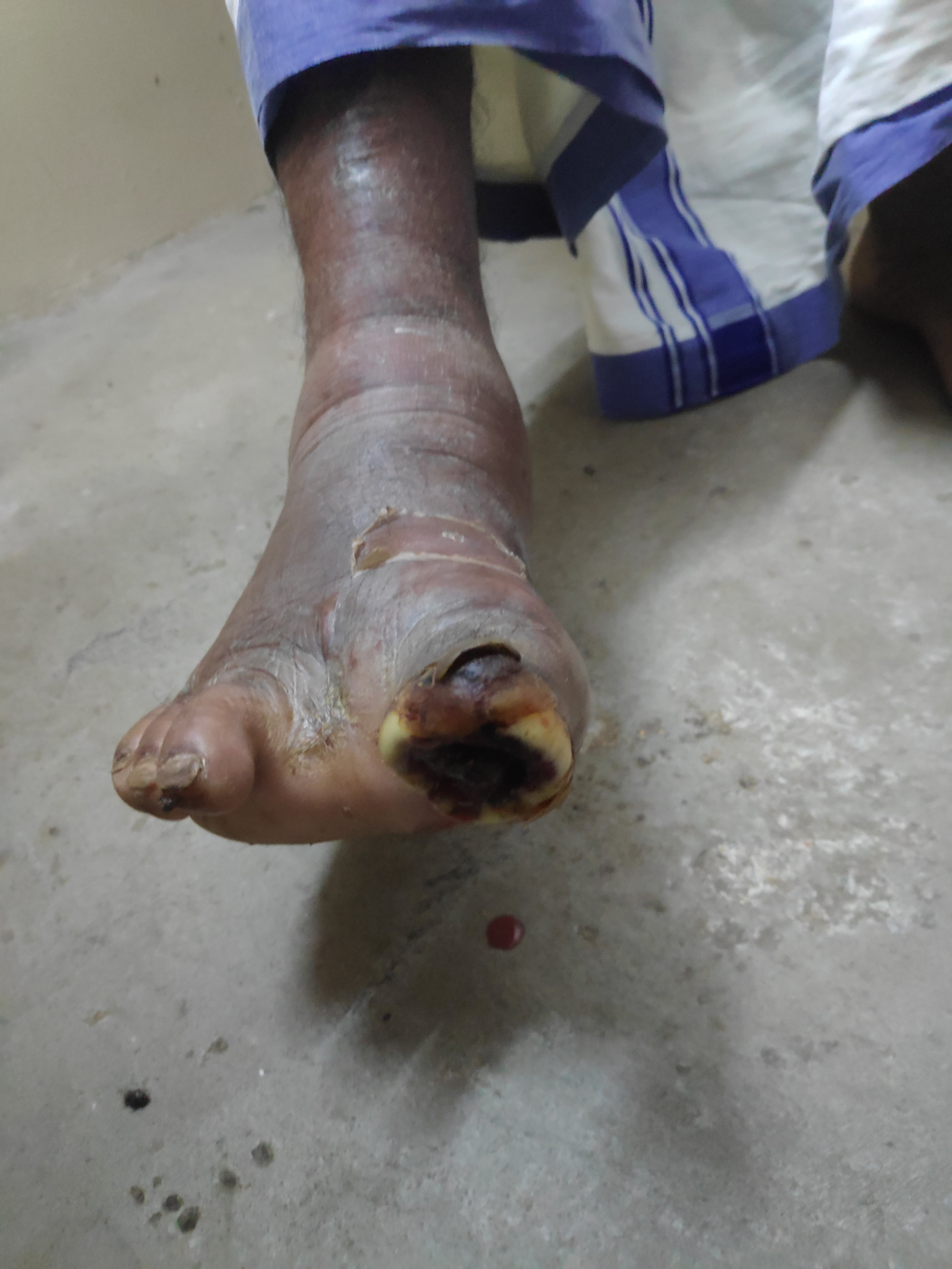 Diabetic foot with a necrotic forefoot wound and swollen skin