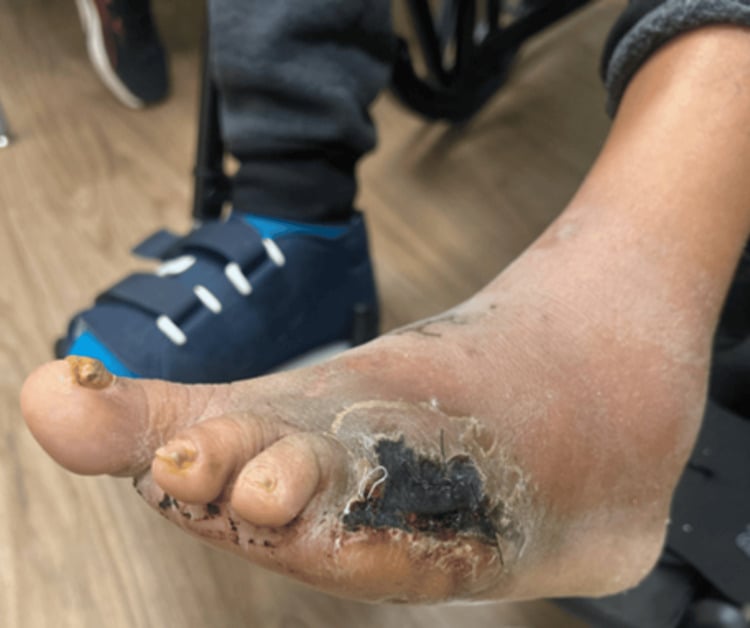 Lateral border of a diabetic forefoot after fifth-ray amputation, the wound covered by black eschar with flaking skin around it, the other foot in a walker boot