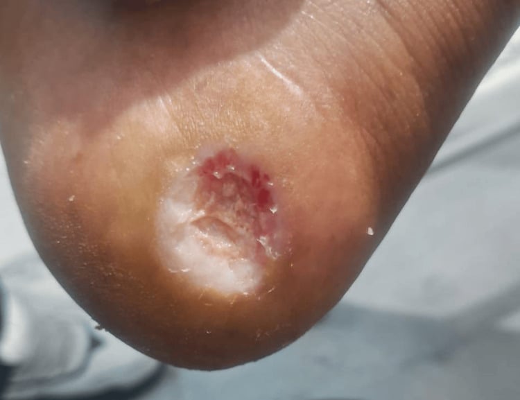 Ischaemic diabetic heel ulcer before revascularisation, with a pale sloughy base and a red rim