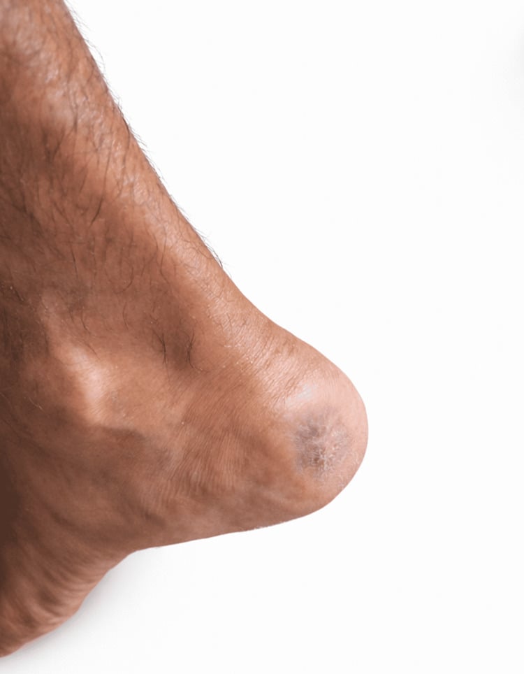 Healed heel after endovascular revascularisation and wound care, with intact skin and a small pale scar