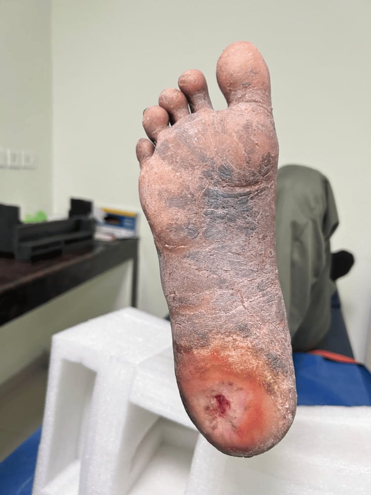 Plantar view of a foot with a small heel ulcer with a red rim, the surrounding skin dry and scaling, after serial total contact casting