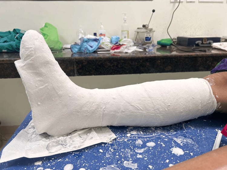 Freshly applied below-knee plaster total contact cast with the toes enclosed, lying on a drape