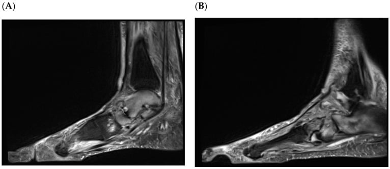 Paired sagittal MRI images showing talonavicular disruption and extensive marrow oedema in active Charcot neuroarthropathy