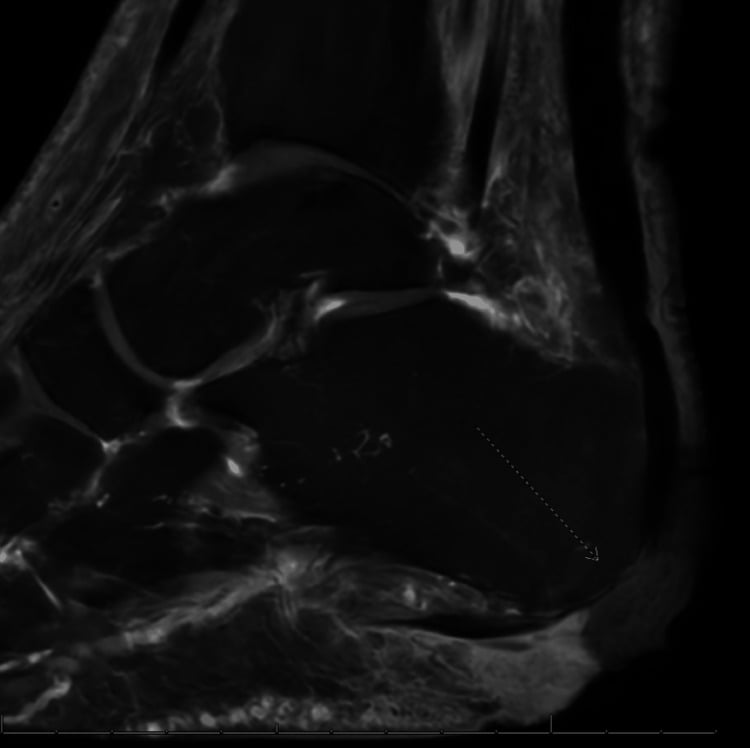 Sagittal foot MRI showing marrow signal abnormality in the calcaneus beneath a plantar heel ulcer