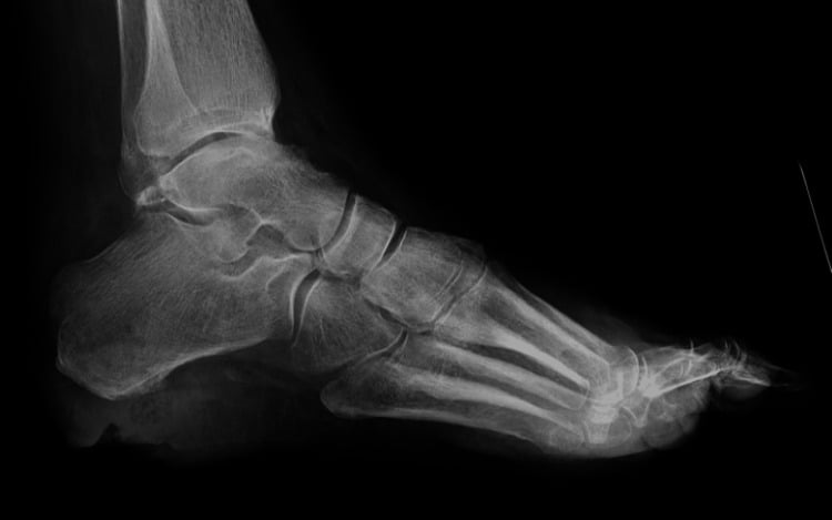 Lateral foot radiograph with plantar calcaneal sclerosis but no definite destructive osteomyelitis