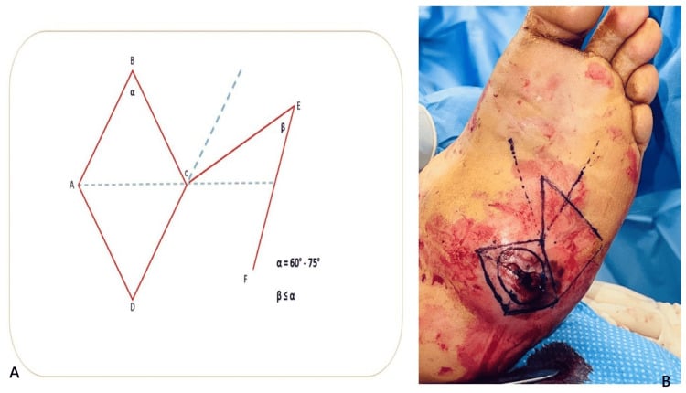 Dufourmentel rhomboid flap geometry beside intraoperative markings around a plantar Charcot ulcer