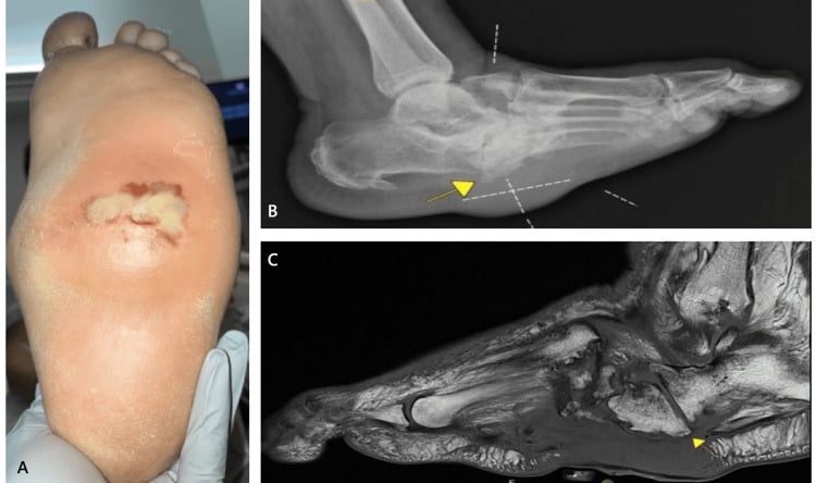 Plantar midfoot ulcer with lateral radiograph and MRI demonstrating a Charcot rocker-bottom deformity and plantar bony prominence