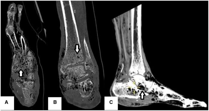 Coronal, axial and sagittal CT images showing intraosseous and soft-tissue gas throughout an infected diabetic foot
