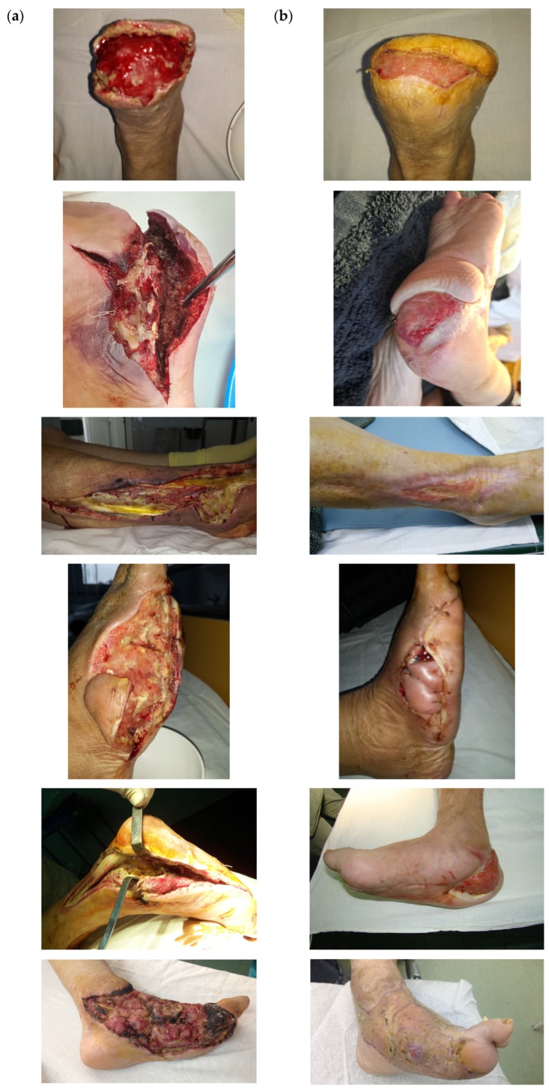 Paired clinical photographs of six diabetic foot and lower-limb wounds before negative-pressure wound therapy and after treatment