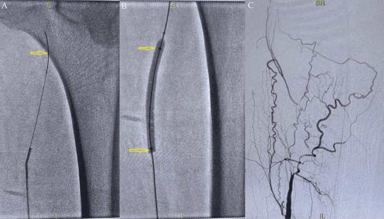 Sequential angiograms showing superficial femoral artery disease, balloon angioplasty and improved distal runoff