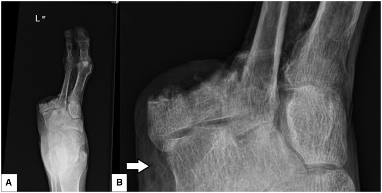 AP foot and ankle radiographs showing soft-tissue emphysema in a diabetic foot infection