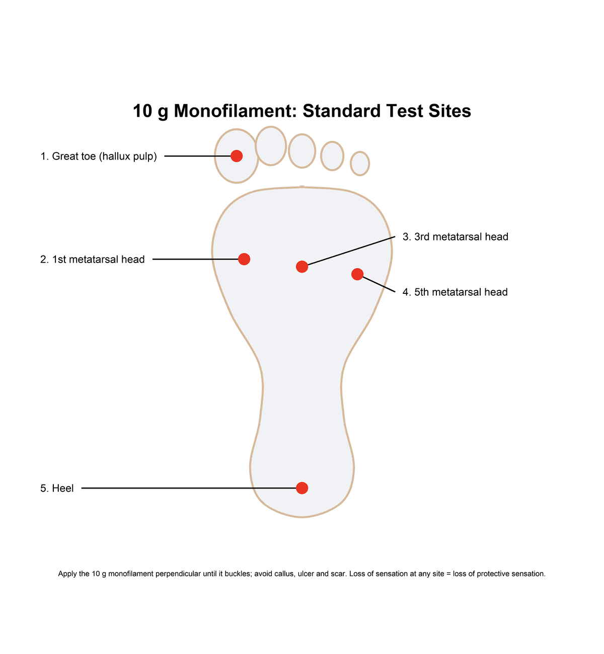 Diagram of the sole of the foot marking the standard 10 g monofilament testing sites: great toe pulp, 1st, 3rd and 5th metatarsal heads, and heel