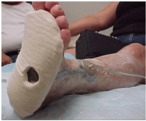 Felt off-loading applied to the plantar foot around a wound as part of diabetic ulcer care
