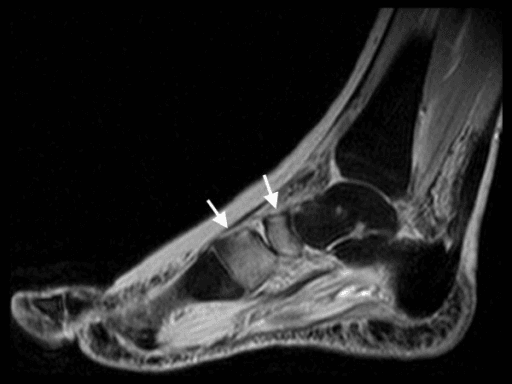 Sagittal STIR MRI of acute Charcot foot stage 0 with navicular and medial cuneiform marrow oedema