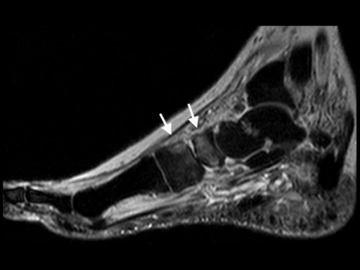 Follow-up sagittal STIR MRI showing regression of Charcot foot marrow and soft-tissue oedema after off-loading