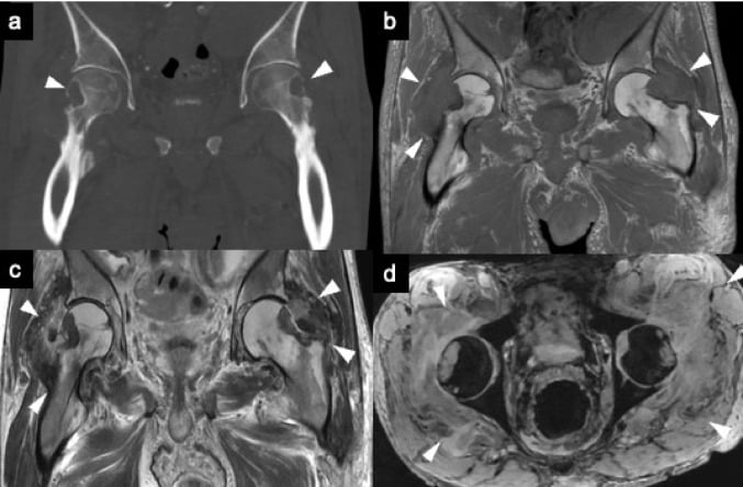Coronal T1 MRI and CT showing bilateral hip amyloid arthropathy and subchondral bone cysts