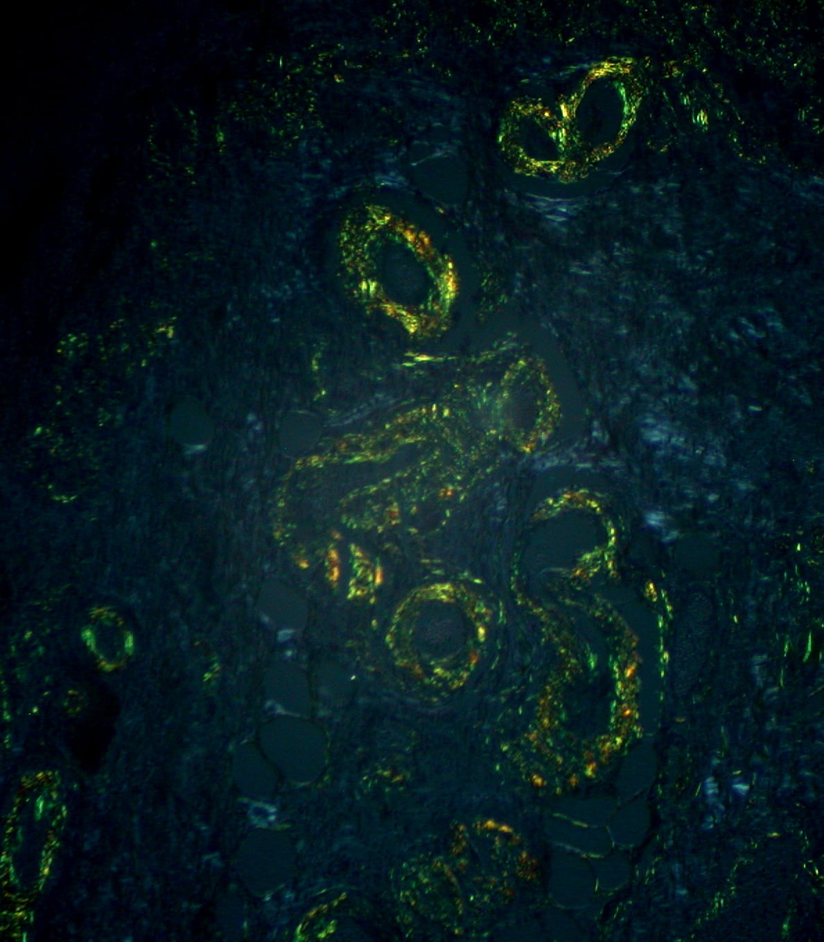 Polarized light microscopy showing apple-green birefringence of Congo red stained amyloid deposits