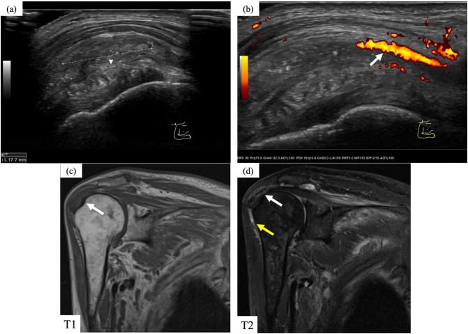 Ultrasound and MRI of shoulder amyloid arthropathy in a dialysis patient
