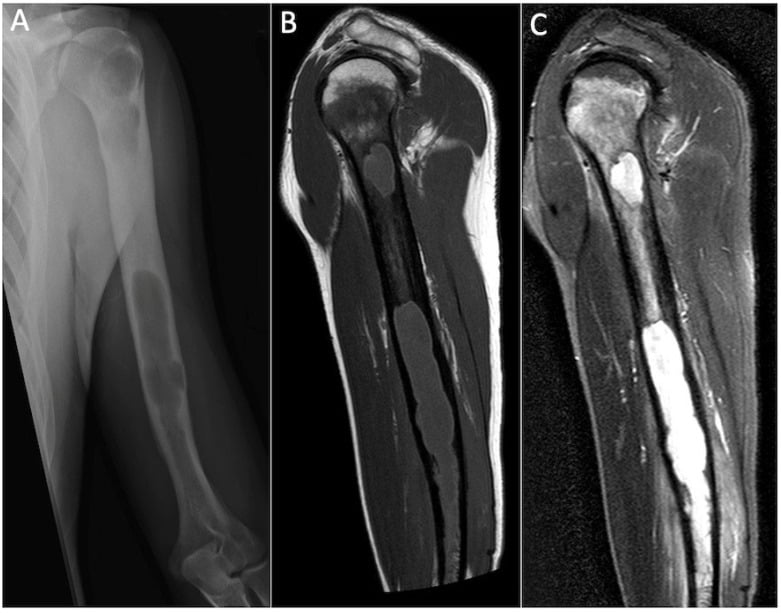 Radiograph and MRI of a diaphyseal abscess with the penumbra sign and surrounding marrow oedema.