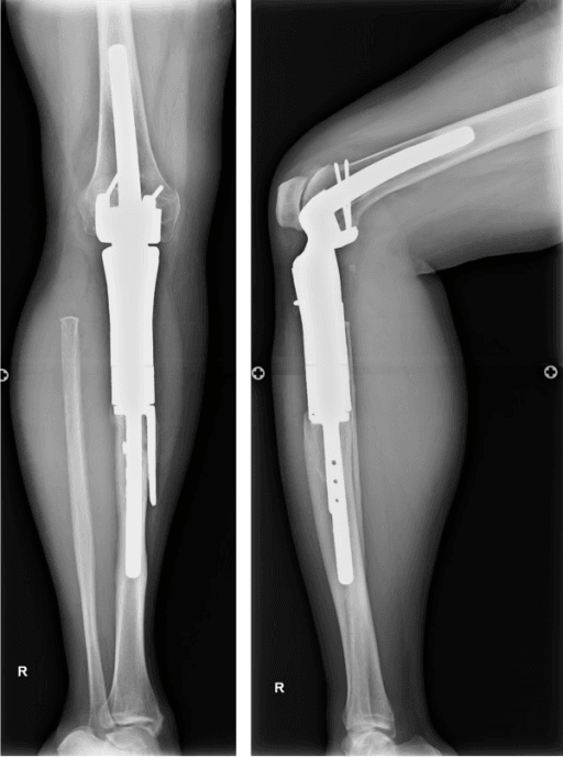 Anteroposterior and lateral radiographs of the tibia showing a metallic modular megaprosthesis replacing the diaphysis.
