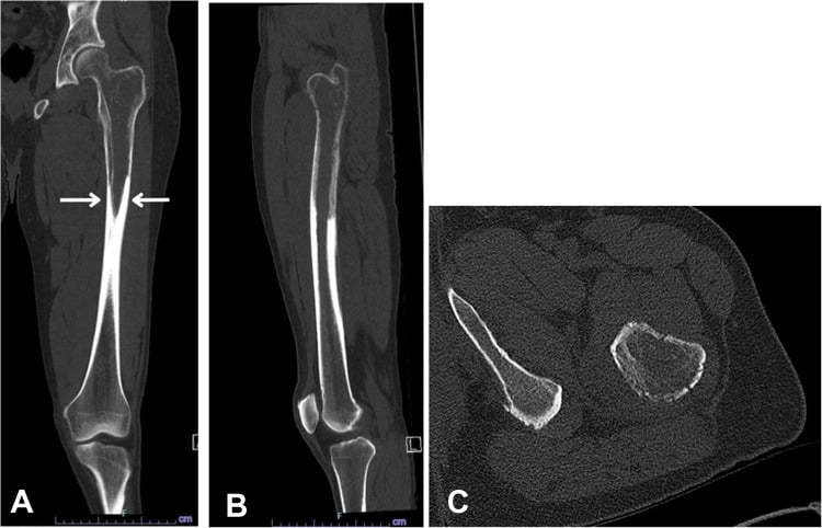 Coronal and axial CT of the proximal diaphysis showing cortical thickening with intracortical lucency and a flame-shaped margin.