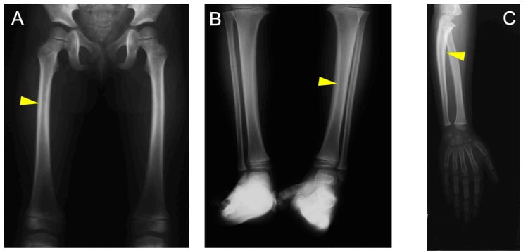 Long-bone radiographs at age three showing symmetric cortical thickening of femur, tibia and ulna.